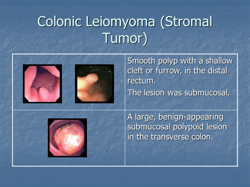 Colonic Leiomyoma (Stromal Tumor)